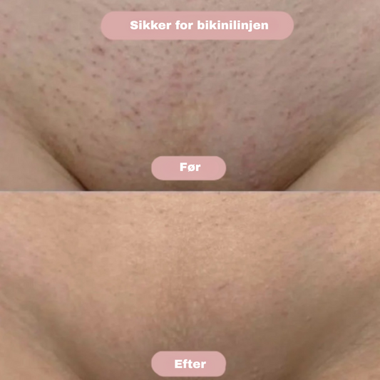 SoftShave – Sig farvel til irritation, rifter og usikkerhed